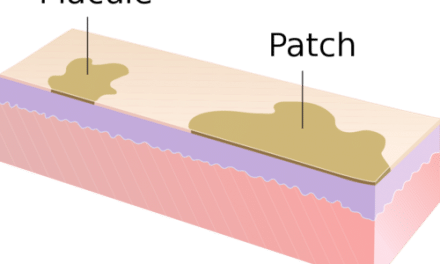 Dental Dermatology Terms: Macules and Patches